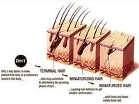 Causes of Hair Loss